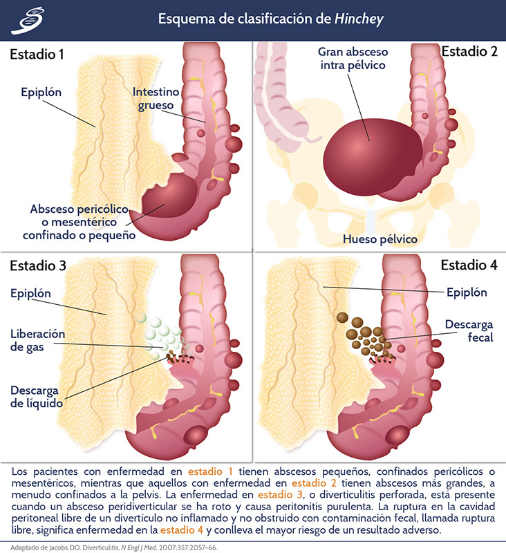 Síntomas diverticulitis: un dolor agudo bajo el abdomen