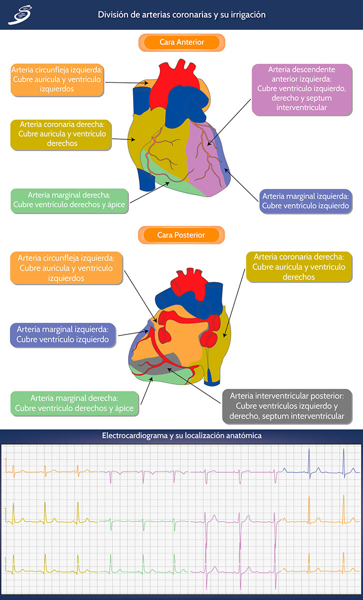 electrocardiograma de infarto de miocardio lateral