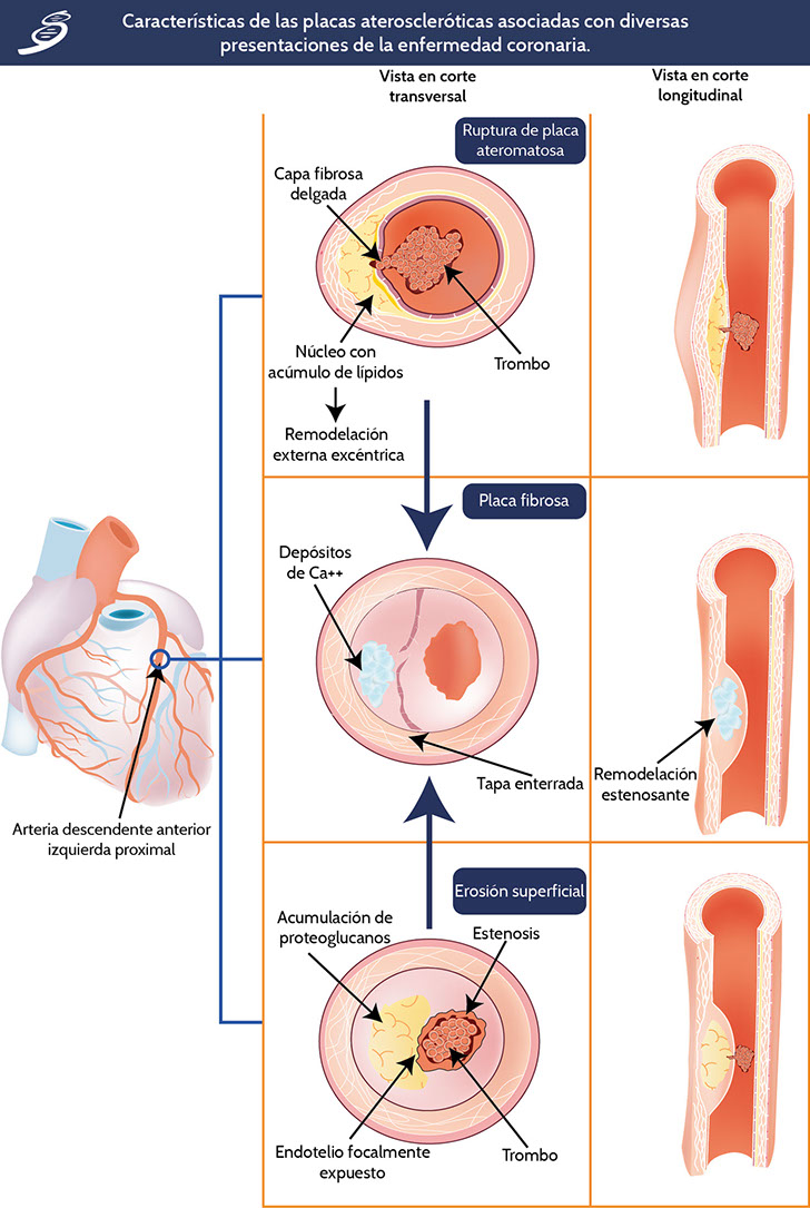 muestra de placa de aterosclerosis